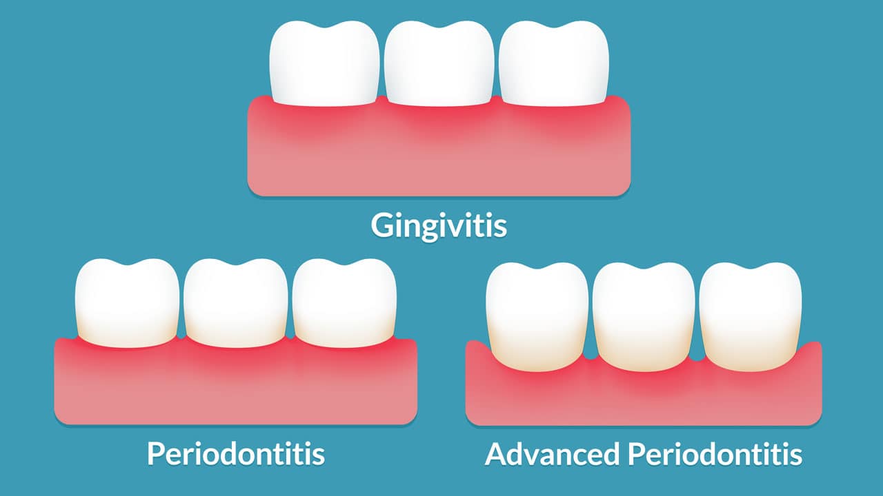 Care este diferența dintre gingivită și parodontită
